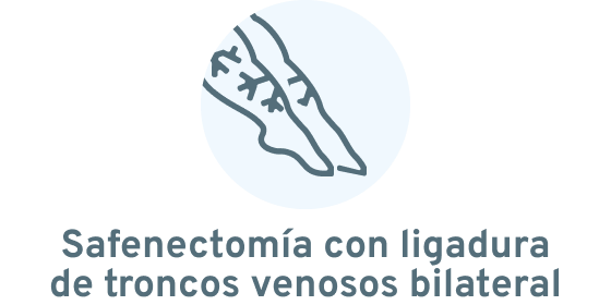 Safenectomía con ligadura de troncos venosos bilateral